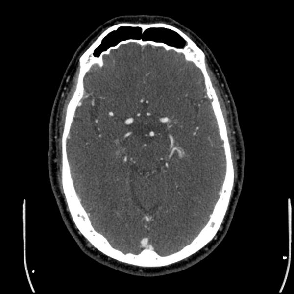 File:Acute A3 occlusion with ACA ischemic penumbra (CT perfusion) (Radiopaedia 72036-82527 Axial C+ arterial phase thins 96).jpg