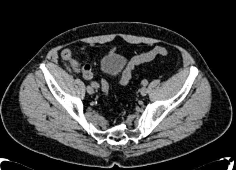 File:Acute appendicitis (Radiopaedia 13030-13091 Axial non-contrast 69).jpg