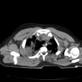 Acute aspiration pneumonitis (Radiopaedia 33605-34703 Axial non-contrast 25).jpg