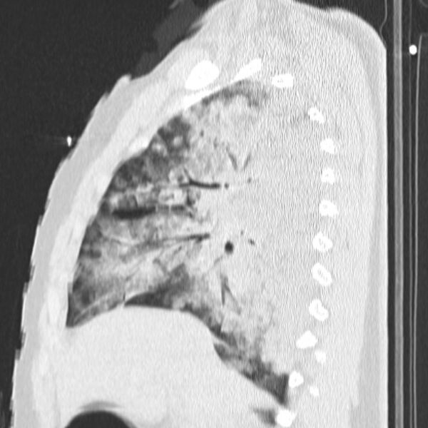 File:Acute aspiration pneumonitis (Radiopaedia 33605-34703 Sagittal lung window 34).jpg
