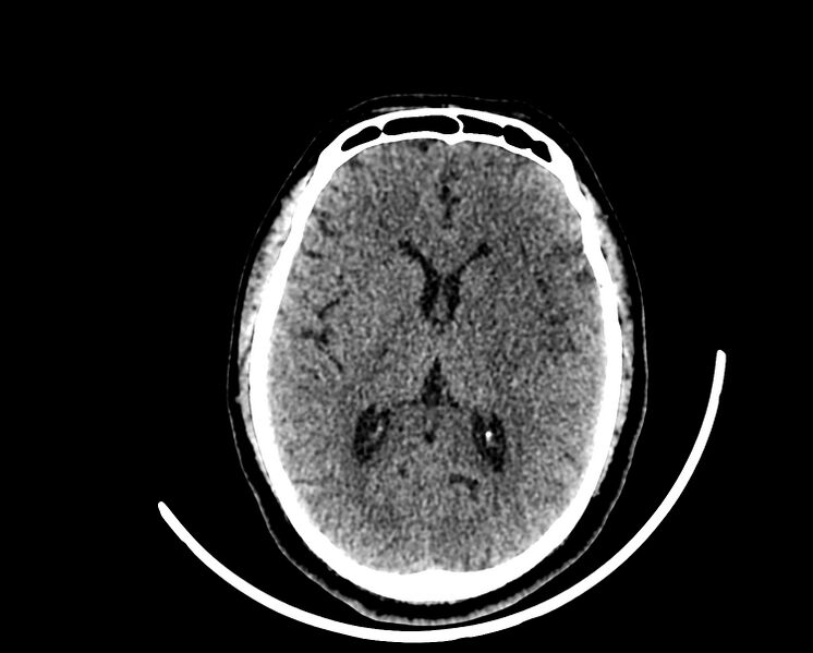 File:Acute cerebral infarct (Radiopaedia 35604-37123 Axial non-contrast 54).jpg