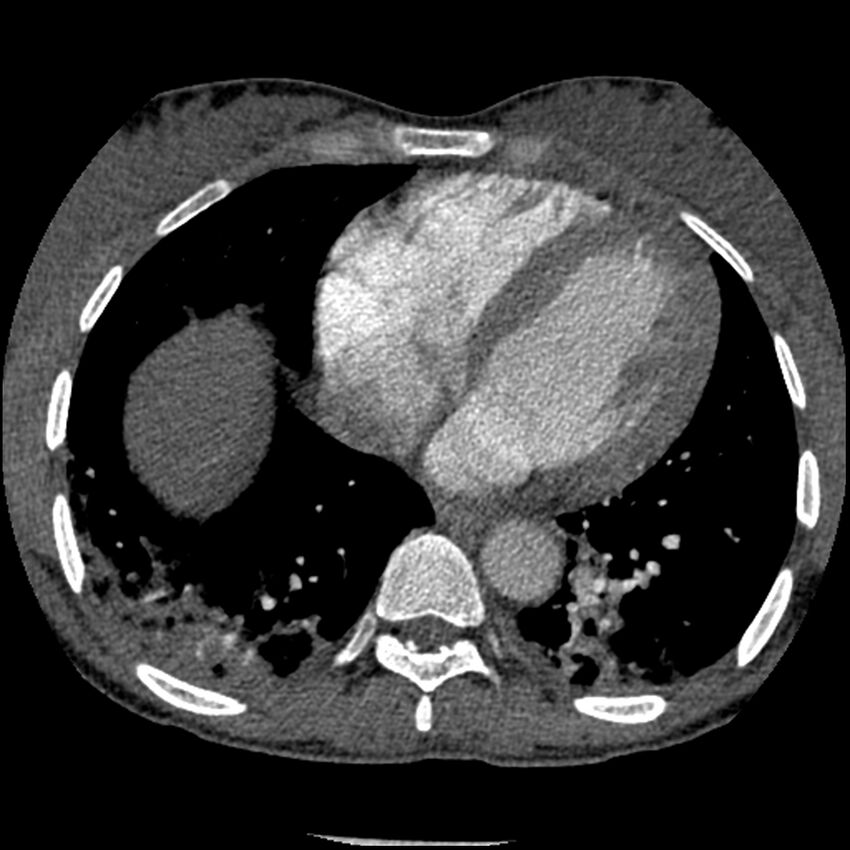 Acute chest syndrome - sickle cell disease (Radiopaedia 42375-45499 Axial C+ CTPA 134).jpg