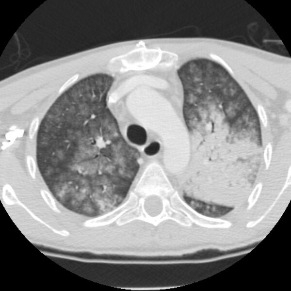 File:Acute diffuse alveolar hemorrhage (Radiopaedia 41323-44158 Axial lung window 15).jpg