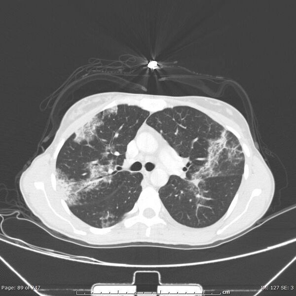 File:Acute eosinophilic pneumonia (Radiopaedia 48211-53073 Axial 1).jpg