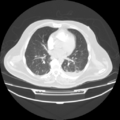 Acute heart failure (CT) (Radiopaedia 79835-93075 Axial lung window 26).png