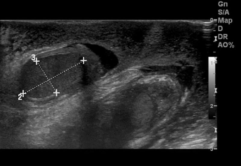 File:Acute idiopathic scrotal edema (Radiopaedia 25903-26051 A 1).jpg