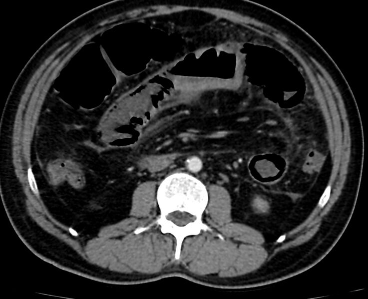 File:Acute mesenteric ischemia - superior mesenteric artery thrombosis (Radiopaedia 73947-84776 Axial C+ arterial phase 58).jpg