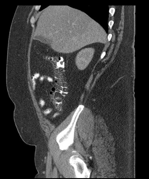 File:Acute mesenteric venous ischemia (Radiopaedia 46041-50383 Sagittal C+ portal venous phase 25).jpg