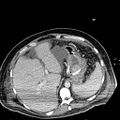 Acute pancreatic necrosis (Radiopaedia 13560-18501 Axial C+ portal venous phase 26).jpg