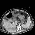 Acute pancreatic necrosis (Radiopaedia 13560-18501 Axial C+ portal venous phase 30).jpg