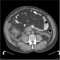 Acute pancreatitis (Radiopaedia 19135-19116 Axial non-contrast 32).jpg