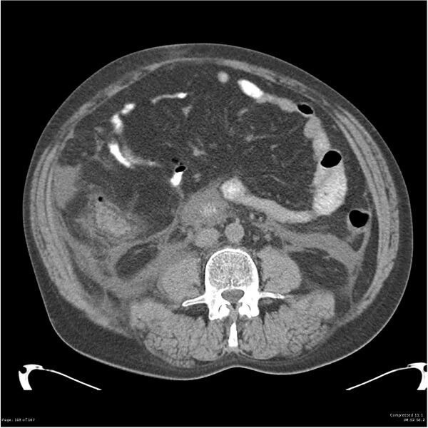 File:Acute pancreatitis (Radiopaedia 19135-19116 Axial non-contrast 32).jpg