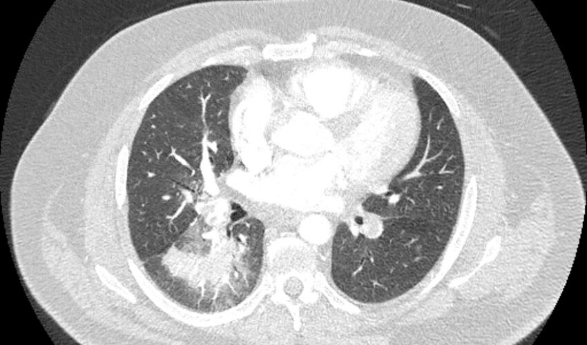 Acute pulmonary embolism with pulmonary infarcts (Radiopaedia 77688-89908 Axial lung window 63).jpg