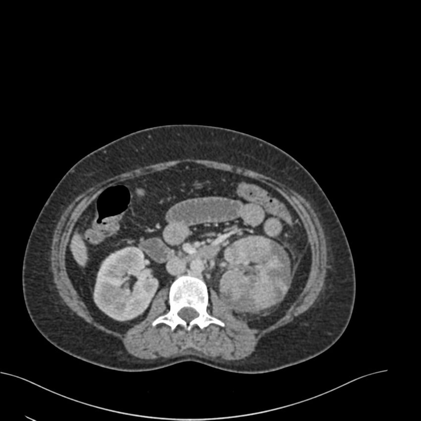 Acute pyelonephritis with renal vein thrombosis (Radiopaedia 58020-65053 Axial renal parenchymal phase 71).jpg