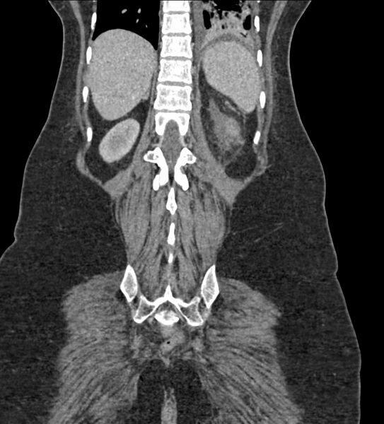 File:Acute pyelonephritis with renal vein thrombosis (Radiopaedia 58020-65053 Coronal renal parenchymal phase 108).jpg