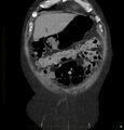 Acute renal failure post IV contrast injection- CT findings (Radiopaedia 47815-52557 Coronal non-contrast 5).jpg
