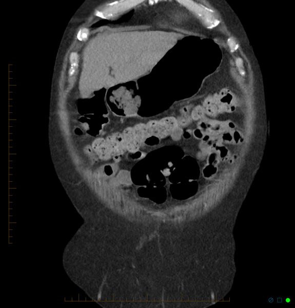 File:Acute renal failure post IV contrast injection- CT findings (Radiopaedia 47815-52557 Coronal non-contrast 5).jpg