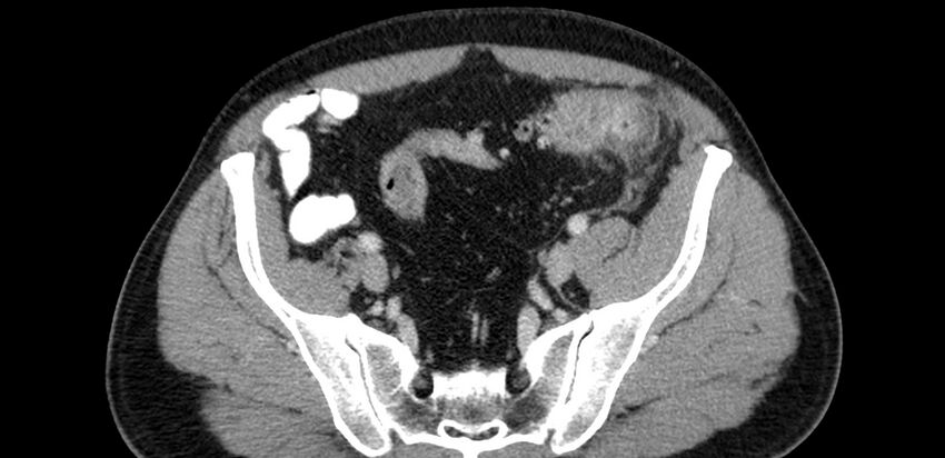 Acute sigmoid colon diverticulitis (Radiopaedia 55507-61976 Axial C+ portal venous phase 81).jpg