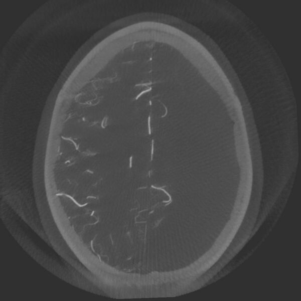 File:Acute subarachnoid hemorrhage and accessory anterior cerebral artery (Radiopaedia 69231-79010 Axial arterial - MIP 62).jpg
