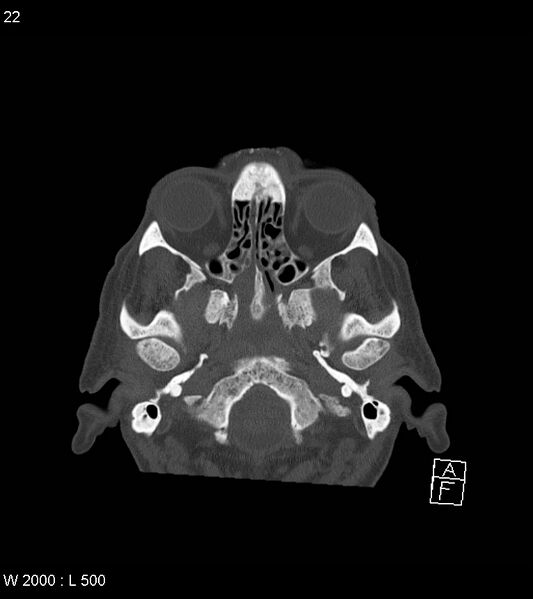 File:Acute subdural hematoma with myelofibrosis (Radiopaedia 52582-58494 Axial bone window 11).jpg