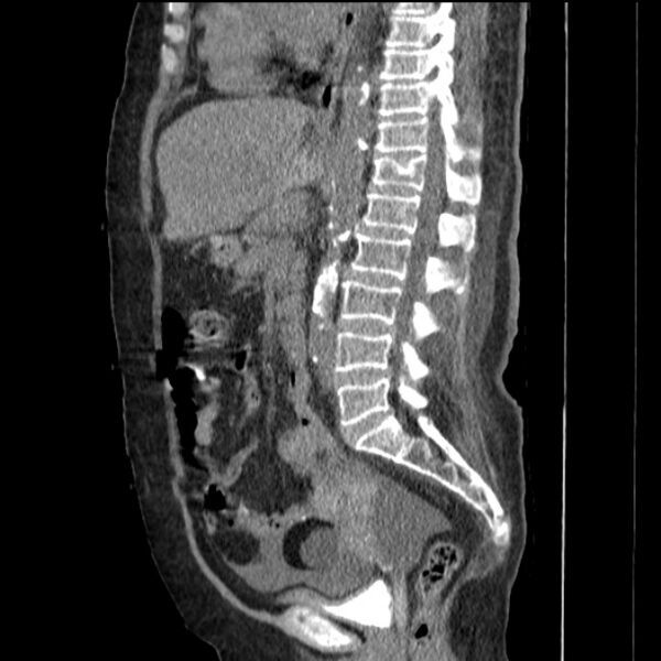 File:Acute tubular necrosis (Radiopaedia 28077-28334 H 46).jpg