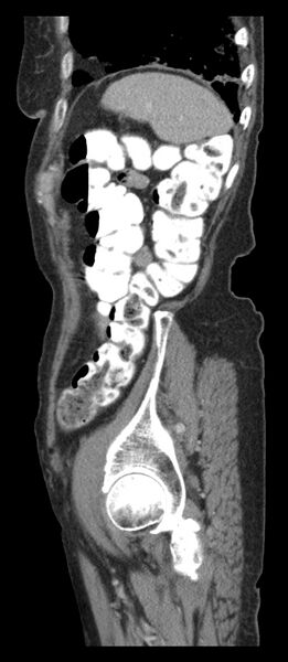 File:Adenocarcinoma of cecum (Radiopaedia 59222-66549 Sagittal C+ portal venous phase 9).jpg