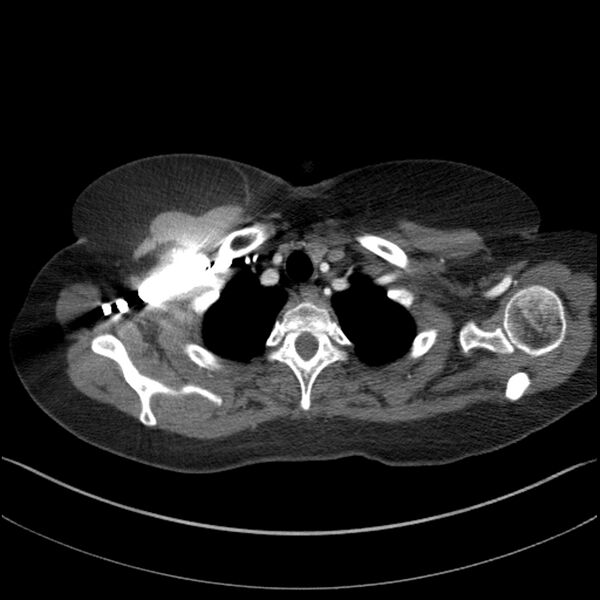File:Adenocarcinoma of the lung (Radiopaedia 44205-47803 Axial C+ portal venous phase 9).jpg
