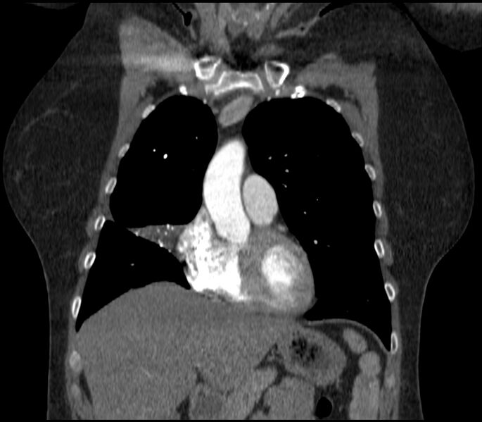 File:Adenocarcinoma of the lung (Radiopaedia 44205-47803 Coronal C+ portal venous phase 27).jpg