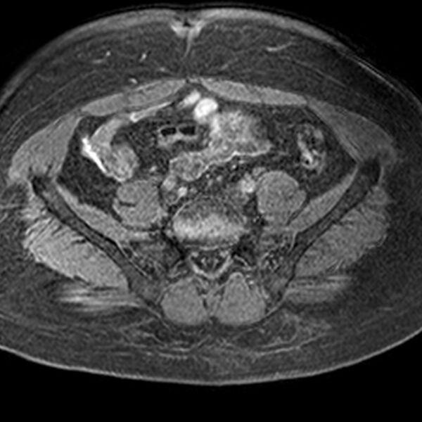 File:Adenomyoma of the uterus (Radiopaedia 9871-10439 Axial T1 fat sat 17).jpg