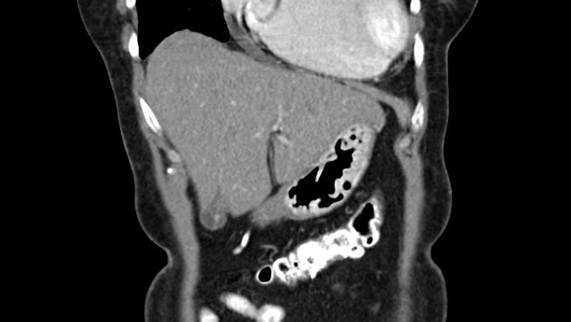 File:Adenomyomatosis of the gallbladder (Radiopaedia 12142-12483 Coronal C+ arterial phase 4).jpg