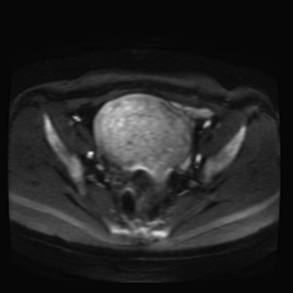 File:Adenomyosis on MRI (Radiopaedia 29328-29780 Axial DWI 6).jpg