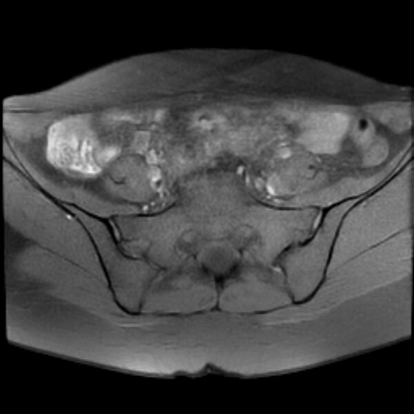 File:Adenomyosis within a septate uterus (Radiopaedia 69963-79981 Axial T1 fat sat 7).jpg