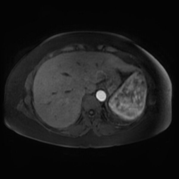 File:Adrenal cortical carcinoma (Radiopaedia 70906-81116 Axial Postcontrast-Dyn T1 fat sat 8).jpg
