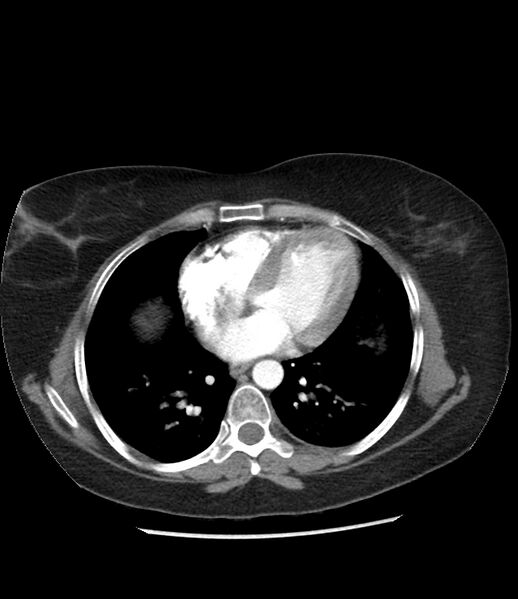 File:Adrenal cortical carcinoma with IVC invasion and thrombosis (Radiopaedia 34307-35597 Axial C+ arterial phase 3).jpg