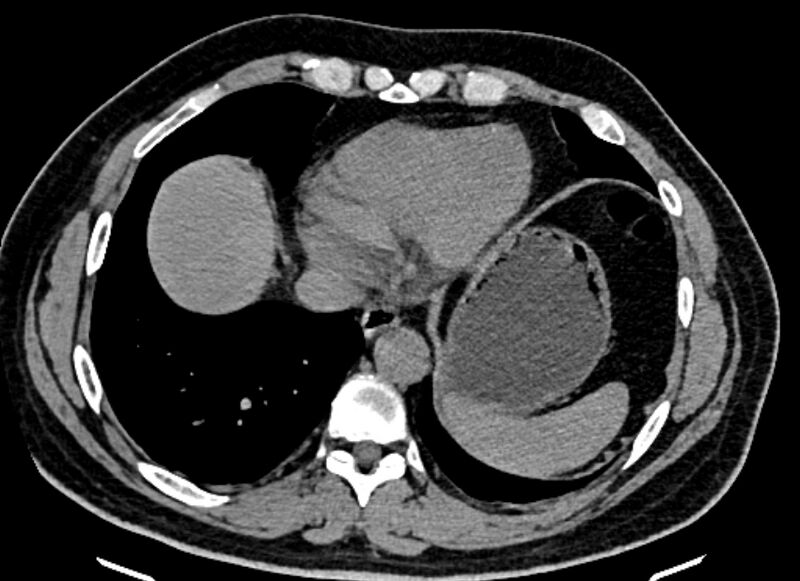 File:Adrenal metastases (Radiopaedia 73082-83791 Axial non-contrast 14).jpg