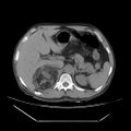 Adrenal myelolipoma (Radiopaedia 41843-44834 Axial non-contrast 18).jpg