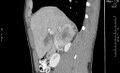 Adrenal pheochromocytoma (Radiopaedia 35133-36726 Sagittal C+ portal venous phase 12).jpg