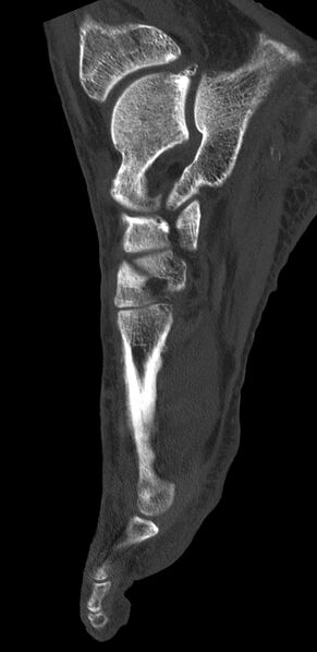 File:Advanced osteomyelitis due to open metatarsal fracture (Radiopaedia 83891-99095 C 11).jpg