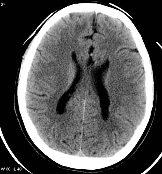 File:Aicardi syndrome (Radiopaedia 5353-7116 Axial non-contrast 24).jpg