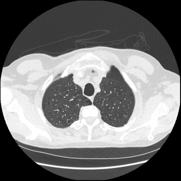 File:Alpha-1-antitrypsin deficiency (Radiopaedia 40993-43722 Axial lung window 30).jpg