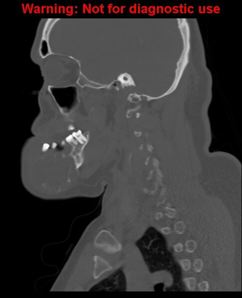 File:Ameloblastoma (Radiopaedia 33126-34164 Sagittal bone window 50).jpg