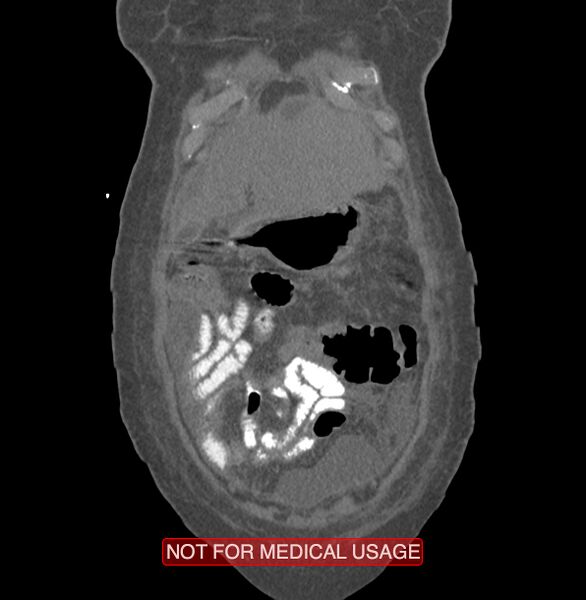 File:Amoebic enterocolitis with liver abscess (Radiopaedia 35100-36609 B 12).jpg