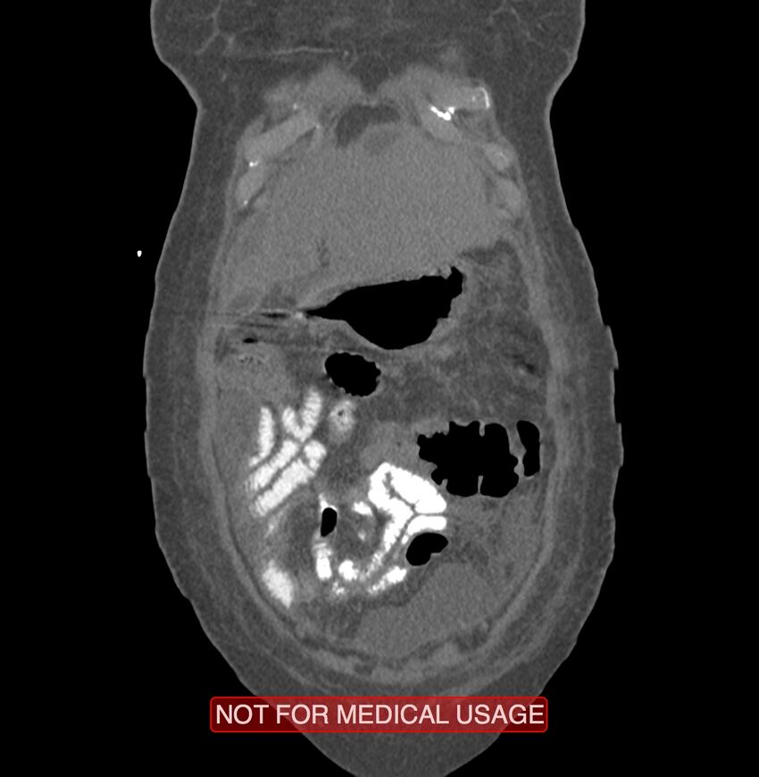 Amoebic enterocolitis with liver abscess (Radiopaedia 35100-36609 B 12).jpg