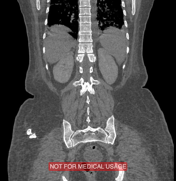 File:Amoebic enterocolitis with liver abscess (Radiopaedia 35100-36609 B 163).jpg