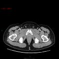 Ampullary carcinoma (Radiopaedia 56396-63056 C 107).jpg