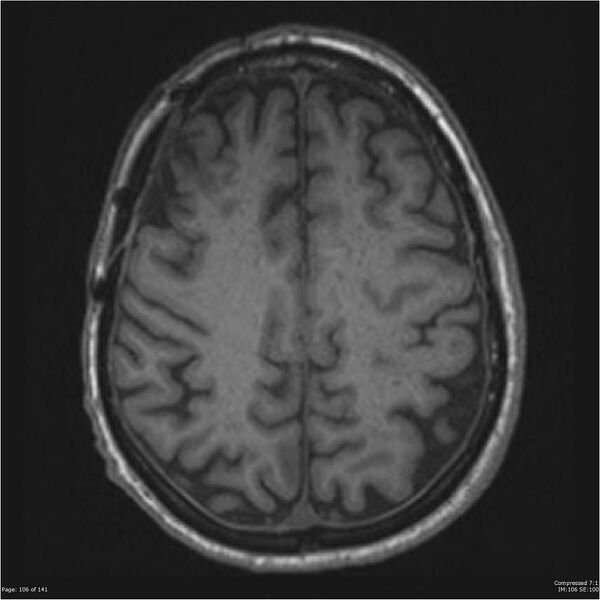 File:Anaplastic meningioma with recurrence (Radiopaedia 34452-35788 Axial T1 104).jpg