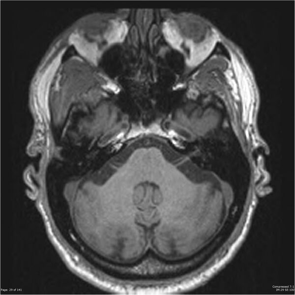 File:Anaplastic meningioma with recurrence (Radiopaedia 34452-35788 Axial T1 27).jpg