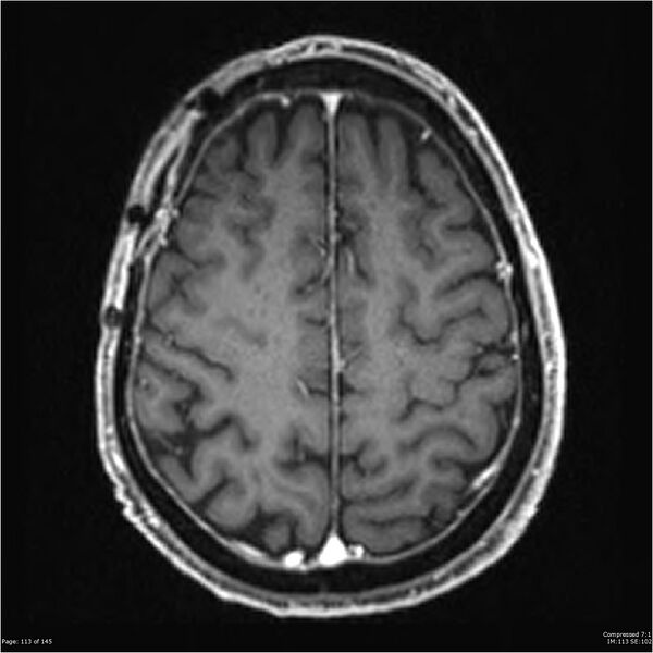 File:Anaplastic meningioma with recurrence (Radiopaedia 34452-35788 Axial T1 C+ 113).jpg