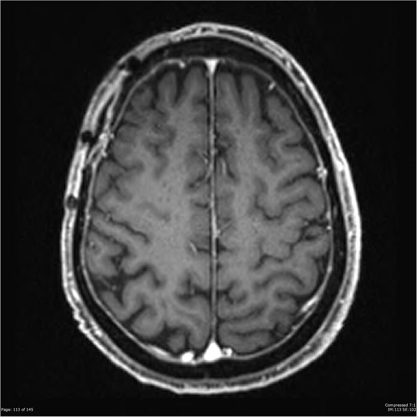 Anaplastic meningioma with recurrence (Radiopaedia 34452-35788 Axial T1 C+ 113).jpg