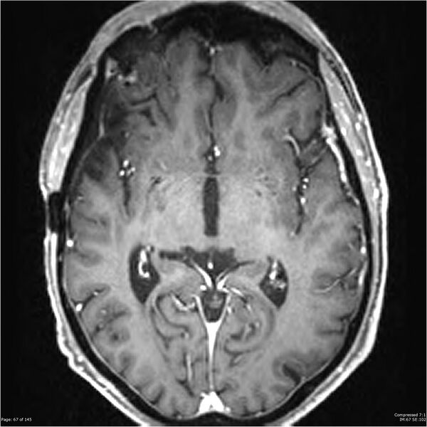 File:Anaplastic meningioma with recurrence (Radiopaedia 34452-35788 Axial T1 C+ 67).jpg